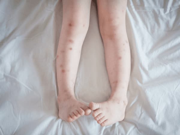 Gambe punte da numerose cimici da letto